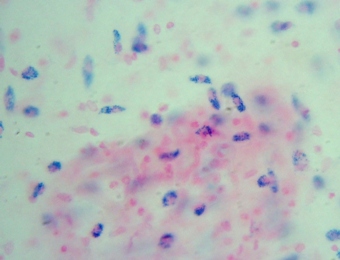 Histiocitos o Macrófagos. Bola de Edema